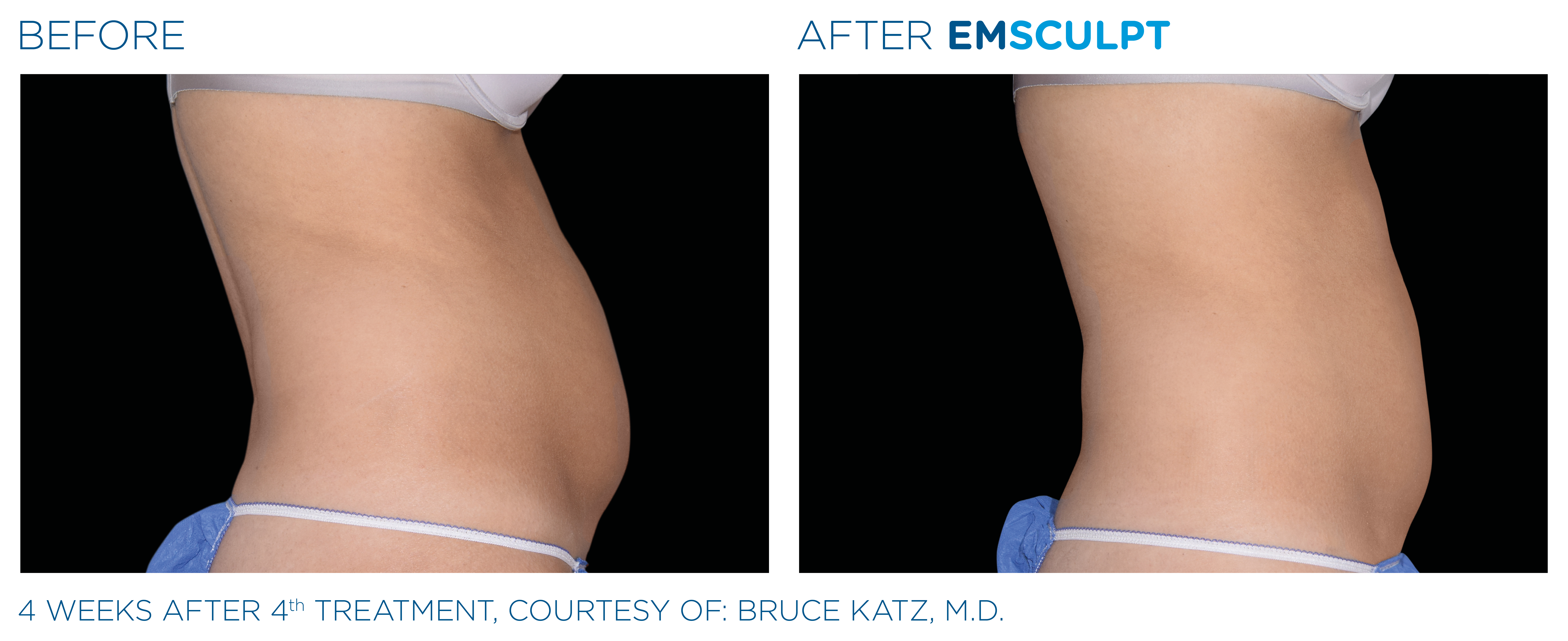 Emsculpt abdomen results - before and after
